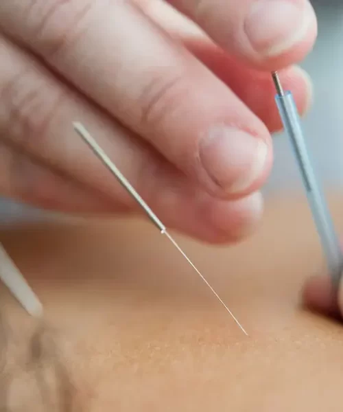 what-is-the-difference-between-dry-needling-and-acupuncture